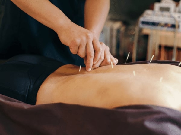 acupuncture therapy service